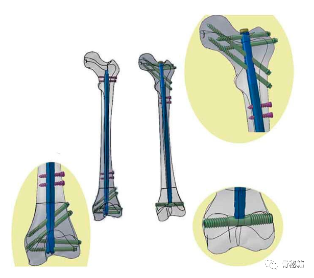 骨科精读|练好髓内钉技术,骨科医生的拿手绝活!