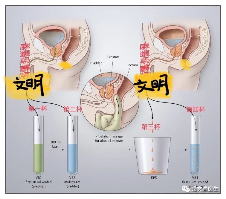 如果准确对前列腺炎进行分类?