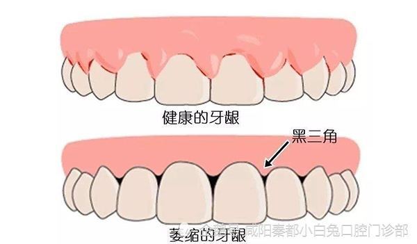 我的牙龈萎缩了还能长回去吗