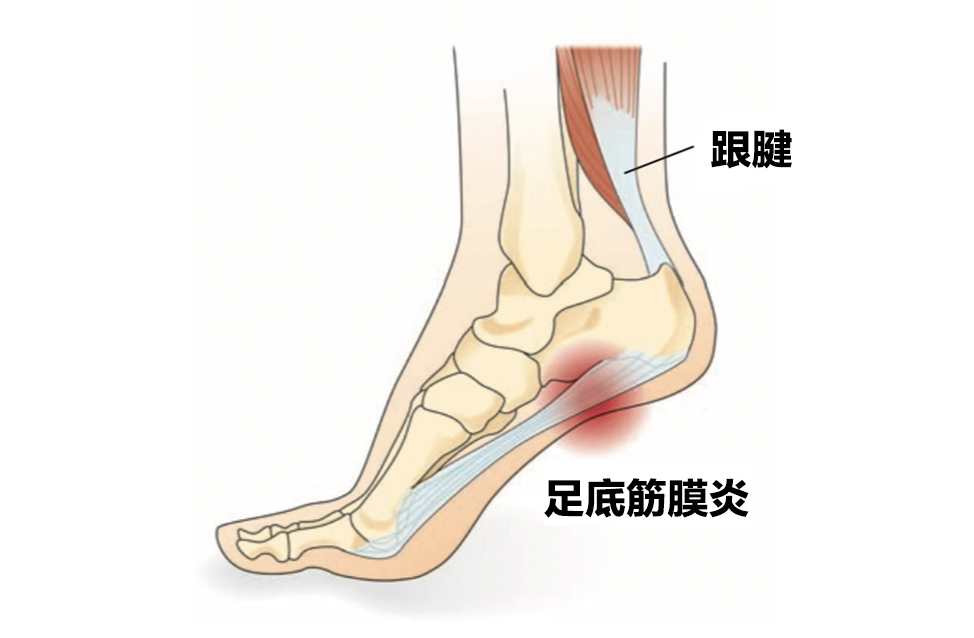 太磨人了跑者易患的足底筋膜炎用这三个动作远离疼痛
