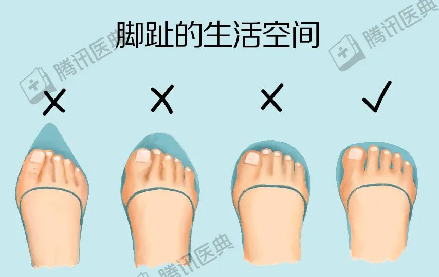 广东这位阿姨跳完广场舞,脚趾竟痛到不能穿鞋!这个病专害女人