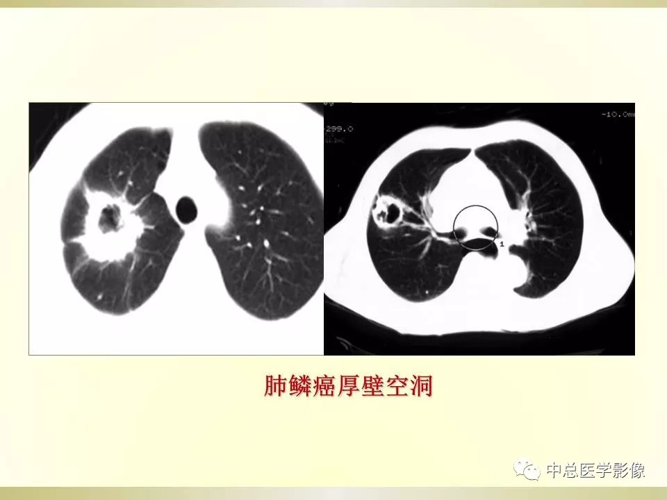 肺部ct征象解读,你都认识吗?