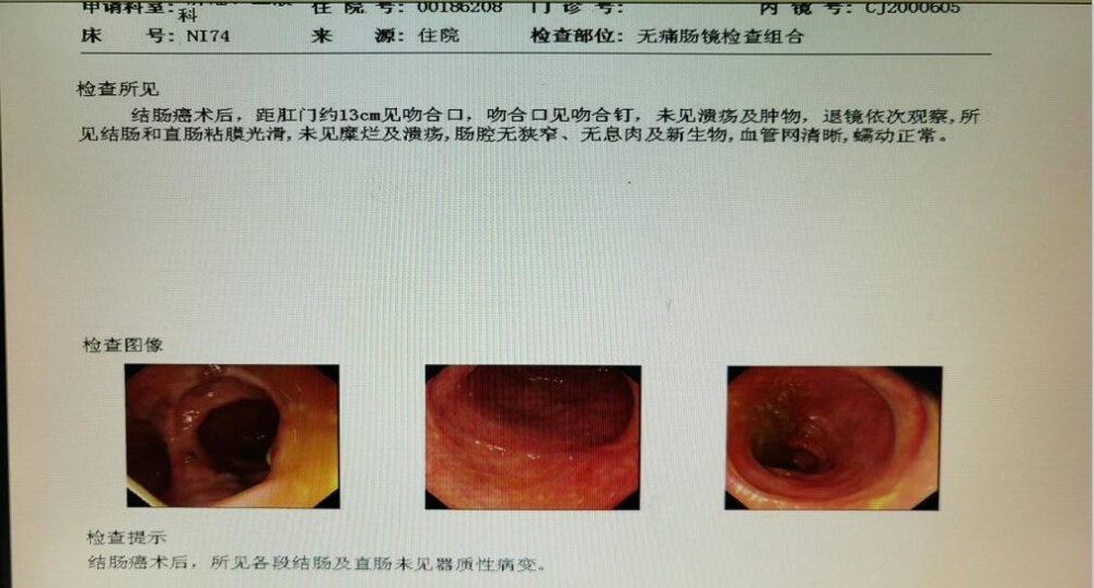 复查结果显示 患者精神,食欲,睡眠,二便都正常,肠镜结果显示无病变.