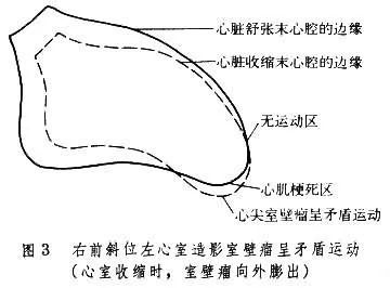 心肌梗死后,为什么有些人的心脏会长出"室壁瘤"?