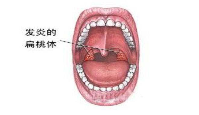 打通咽喉第一经方,咽炎,扁桃体炎,息肉,各种咽喉病一剂见效