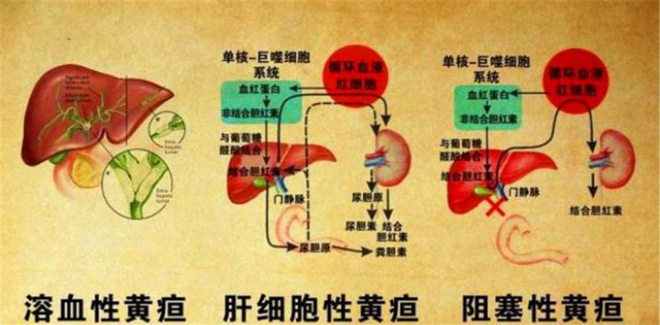 成年人也会得黄疸吗黄疸到底是怎么回事是什么原因造成的