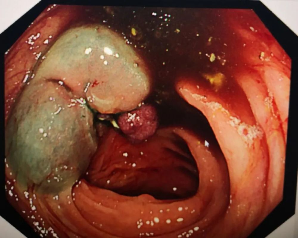 病例|结肠多发性息肉分次切除,内镜下分片黏膜切除术切除巨大息肉一枚