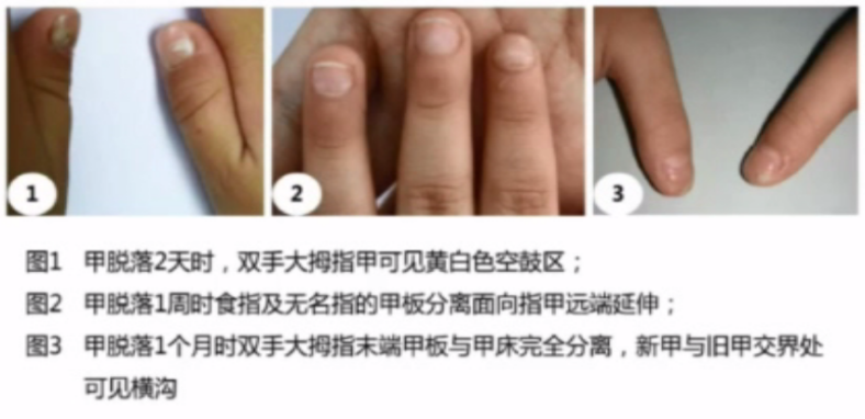 血清中出现igm型嗜异性抗体 手足口病后,指甲脱落/图片来源李萍教授