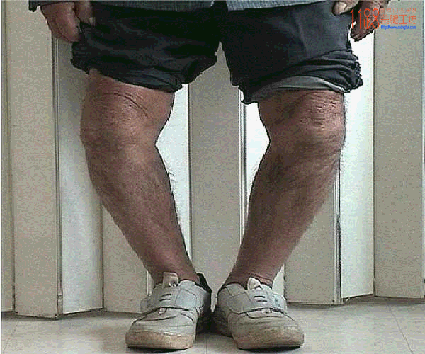 o型腿矫正由o到11弯腿变美腿