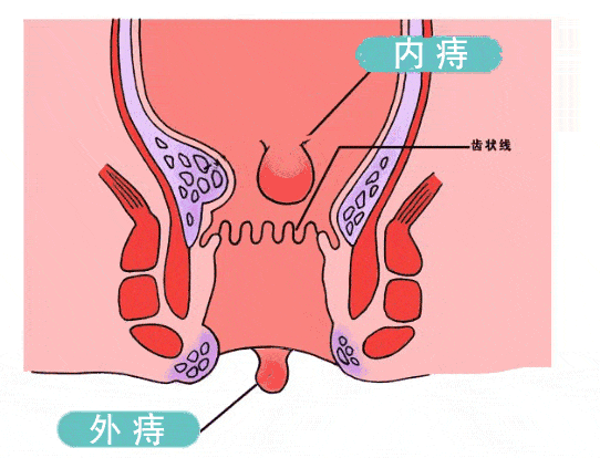 【专家解词】痔疮-记住20字秘诀,让你轻松远离!