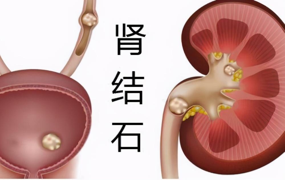 肾结石会引起腰痛吗有这几种情况就要注意了