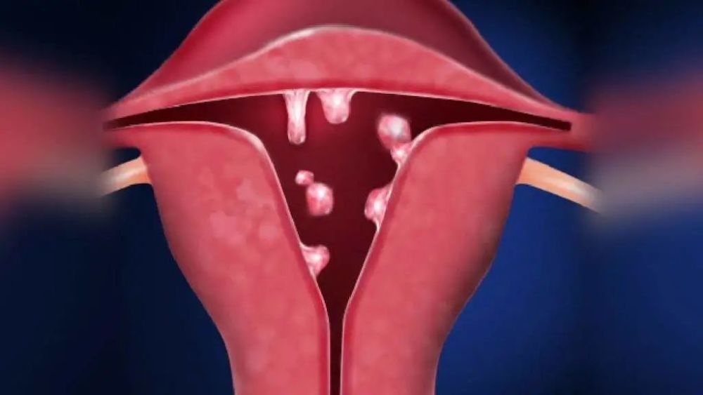子宫内膜息肉会癌变吗?会遗传?能预防吗?