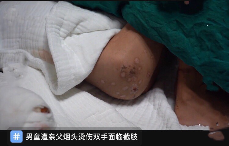广东7岁男童遭父亲烟头烫伤,双手面临截肢,请问父母资格证能取消吗?