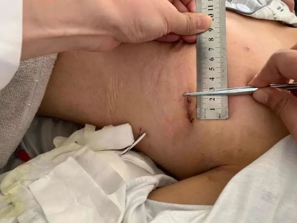 图片来源:公众号「福建卫生报」 手术后第2天,小陈痊愈出院,由于切口