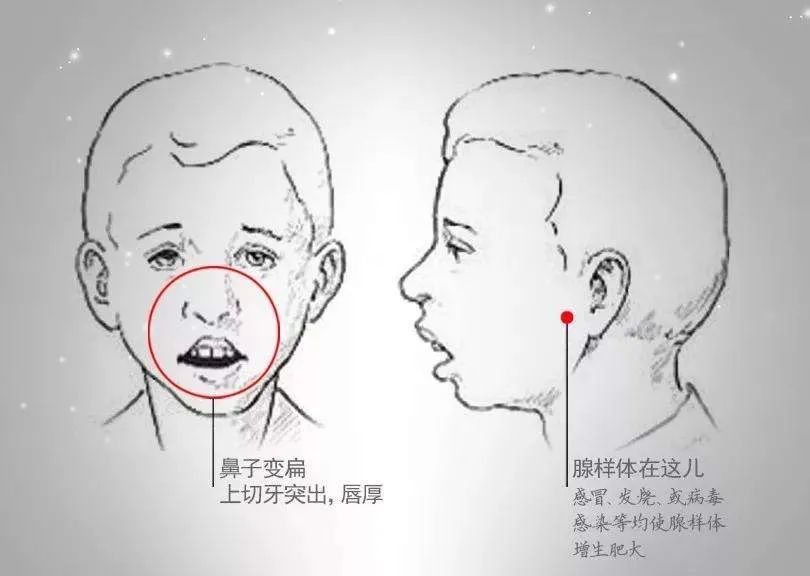 如果外加有精神萎靡,面部表情呆板,愚钝,即成所谓 "腺样体面容".