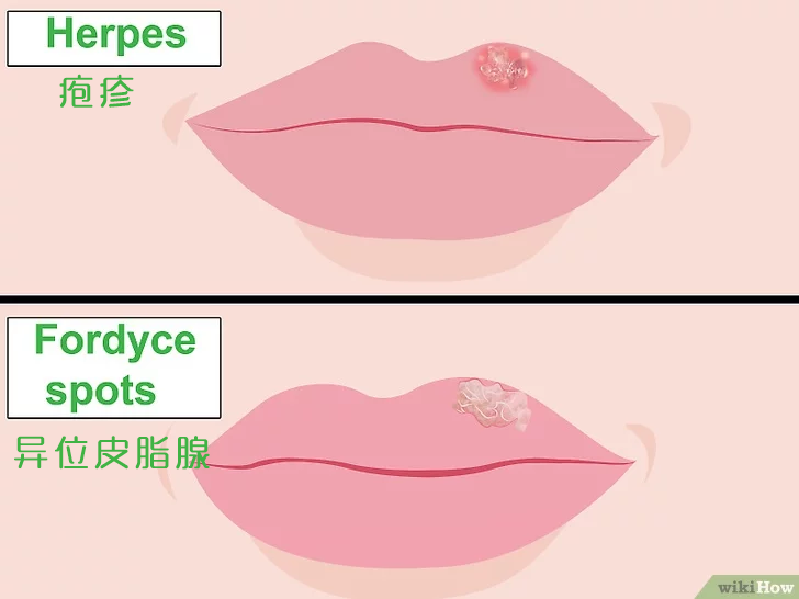 如果嘴唇出现了异位皮脂腺,那么基本就不会消退了,有的随着年龄增长