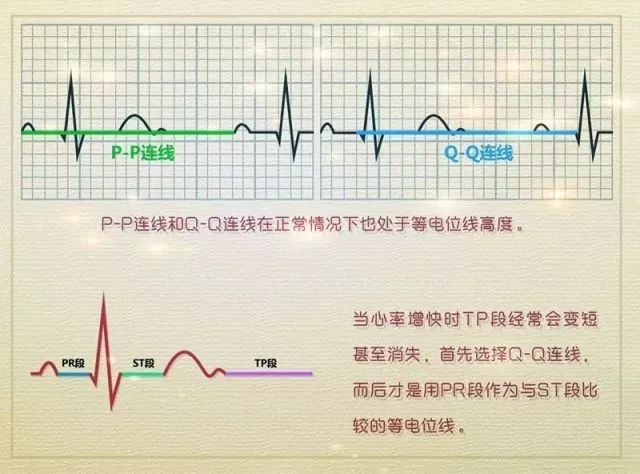 pr段,这三段时间绝大多数心肌细胞都在休息,正常情况下应该在等电位线