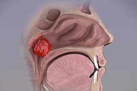 潍坊耳鼻喉医院:小儿腺样体发炎肥大有哪些危害