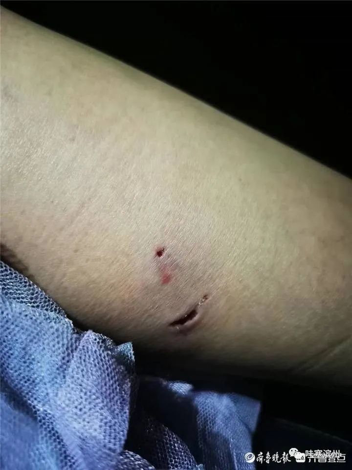 滨州一女士被狗咬伤!伤口很大!