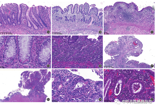 中国炎症性肠病病理诊断专家指导意见