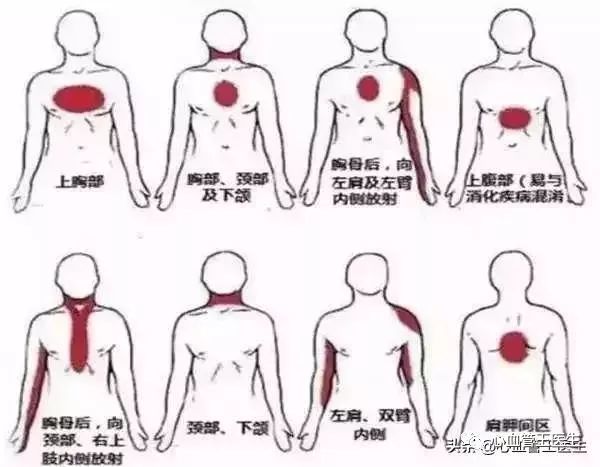 50岁女性,前胸后背疼痛3个月,怎么判断是生气造成,还是冠心病