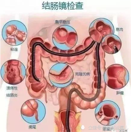 肠镜检查前怎么准备看这10条就够了