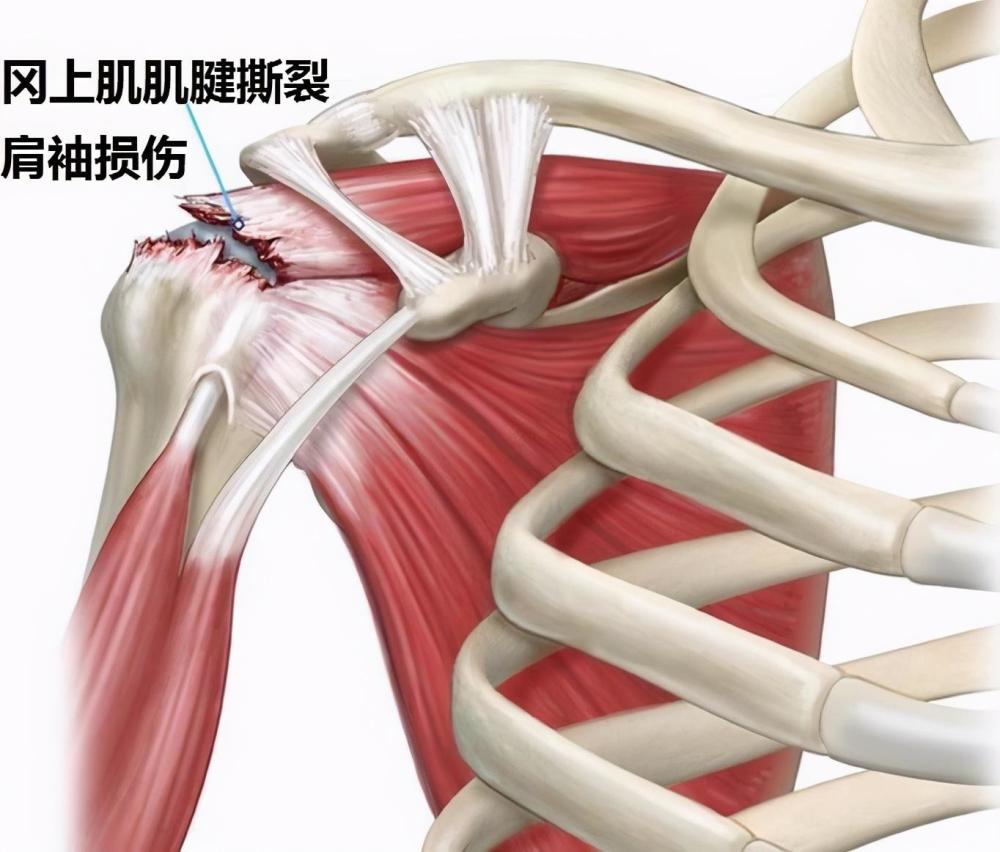 3,神经根型颈椎病神经根型颈椎病导致肩膀疼主要是由于颈椎病骨质增生