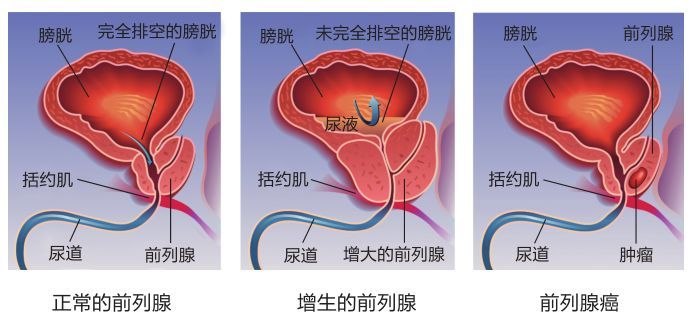 什么是前列腺增生伴钙化?俩种疾病一起来,严重吗?