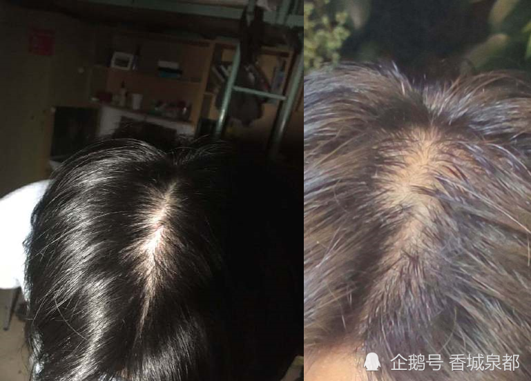 韩脱发人口1000万_脂溢性脱发图片