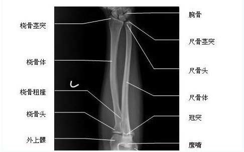 吴京称谢楠桡骨粉碎性骨折桡骨为什么这么容易受损