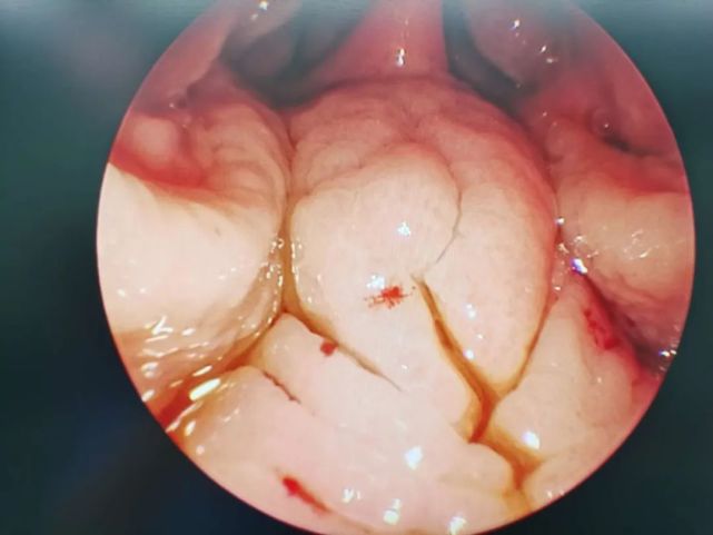 4岁孩子腺样体过度肥大导致呼吸道阻塞,低温等离子