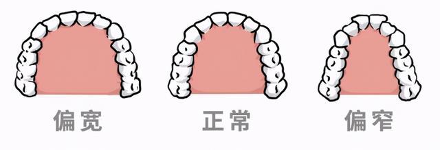 科普丨什么是牙弓如何看宽窄