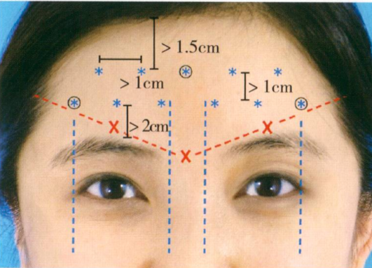 3安全区与双排法(解剖定位 女性患者最外侧的点应尽量不超过瞳孔中线