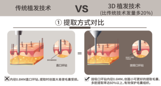 韩国脱发人口1000万_脂溢性脱发图片(2)