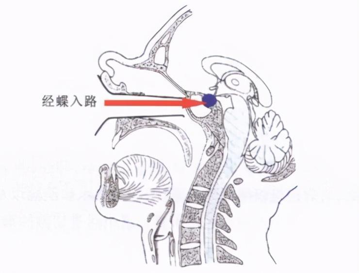 颅咽管瘤可以做微创手术吗?手术以后视力还能恢复吗?