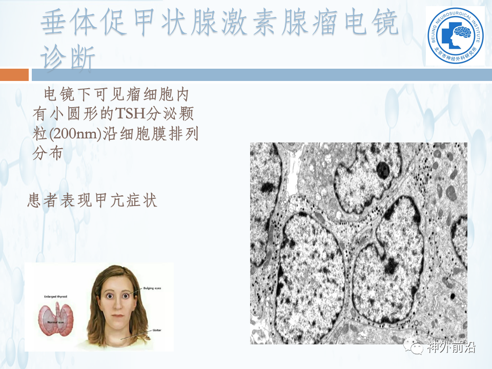 北京神外所课程张翠萍电子显微镜技术在垂体瘤诊断中的应用