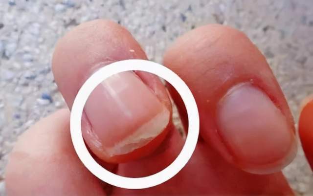 指甲暴露缺陷,身体健康和指甲的关系有多大?