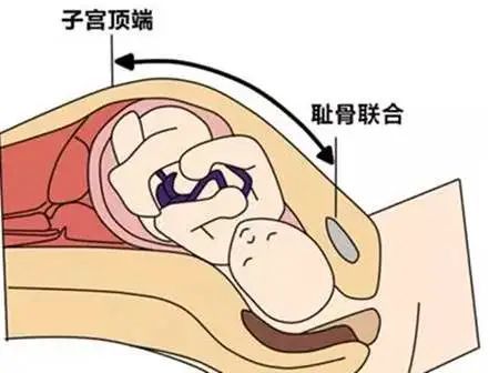 宫底高度就是耻骨联合上缘中点至子宫顶端(宫底)的距离,按孕月来说