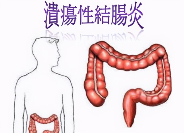 溃疡性结肠炎苦不堪言,教你正确的治疗方法要记牢!