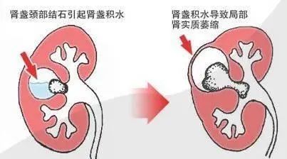结石堵塞了肾盂,输尿管,尿液排出不畅,造成肾积水.