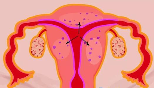子宫肌瘤有什么症状能治好吗?一文读懂子宫腺肌症