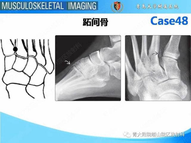 一文掌握|跖跗关节骨折脱位