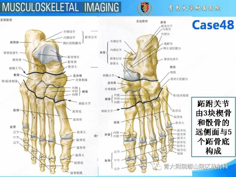 一文掌握跖跗关节骨折脱位