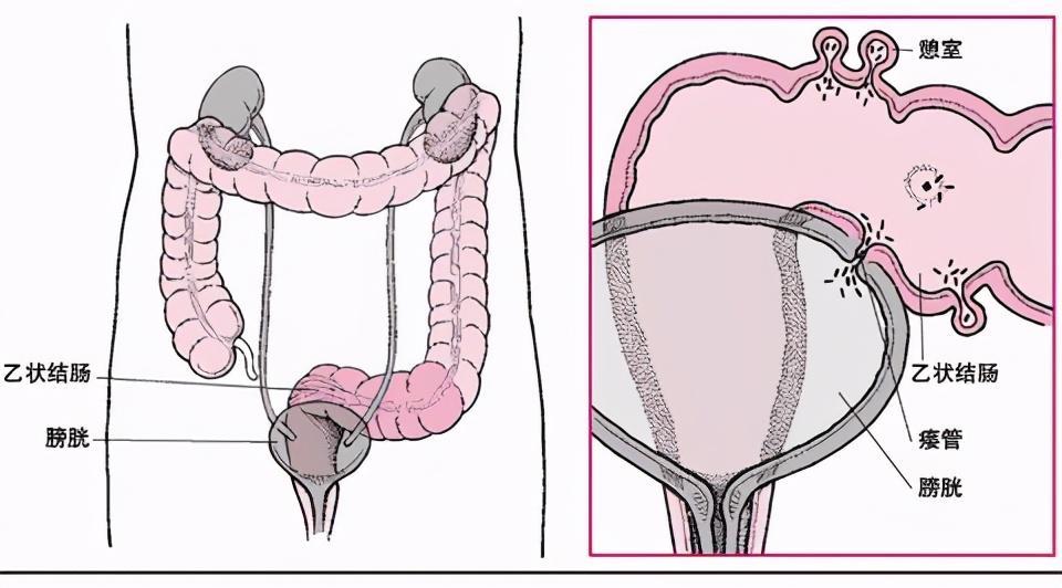 常被误诊为阑尾炎的憩室炎,到底是个什么病?中老年人一定多加注意!