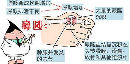 什么是痛风 有哪些症状表现