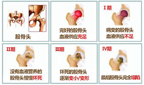 41岁董先生确诊为股骨头坏死,没想到竟是喝酒惹的祸