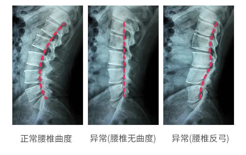 运动员都靠这根"小骨头",一躺,整个腰都舒坦了