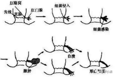 肛瘘都有哪些症状呢?该怎么治疗?