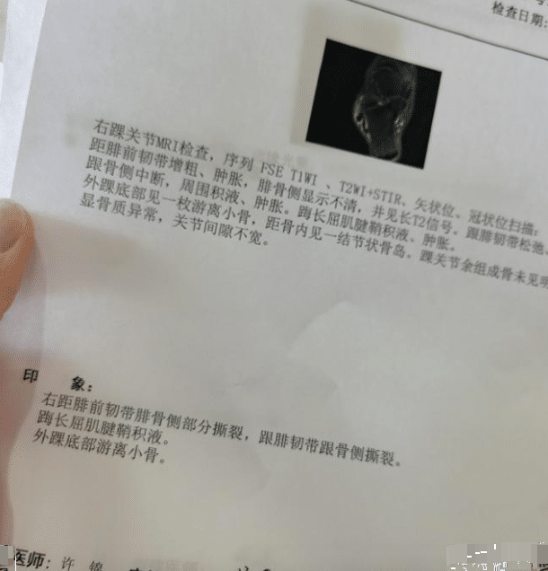 状元脚踝90度弯折 担架进场 救护车直送医院