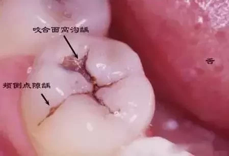 是蛀牙吗?|牙齿|蛀牙|黑线|窝沟龋